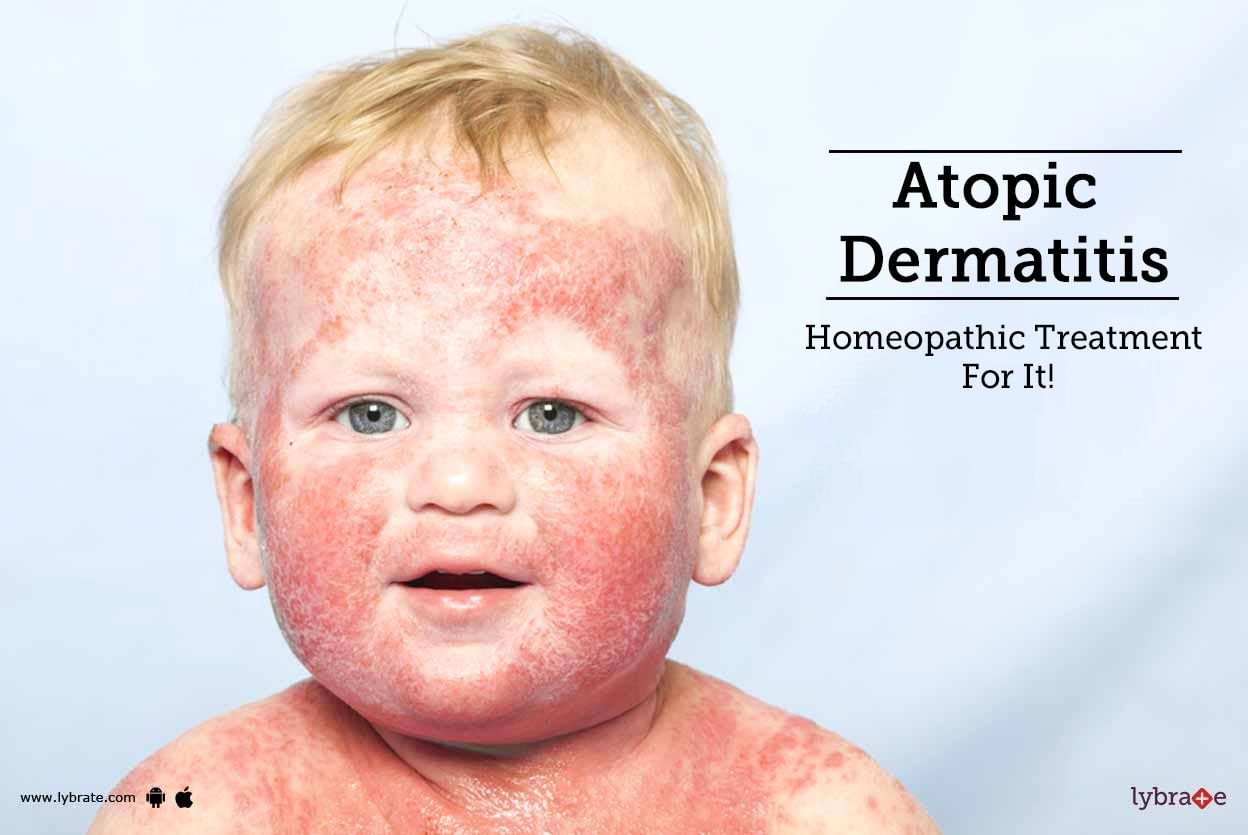 Atopic Dermatitis- Homeopathic Treatment For It!