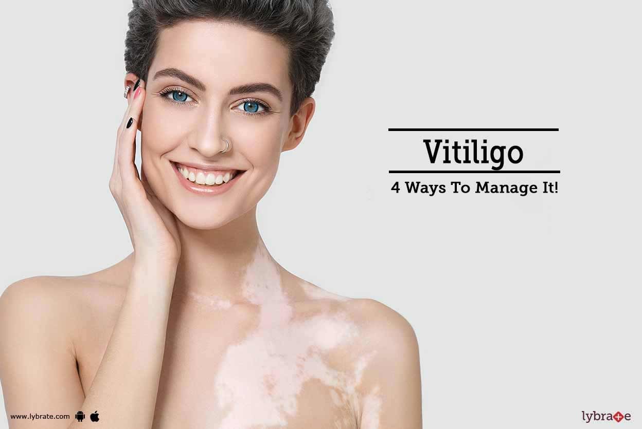 Vitiligo - 4 Ways To Manage It!