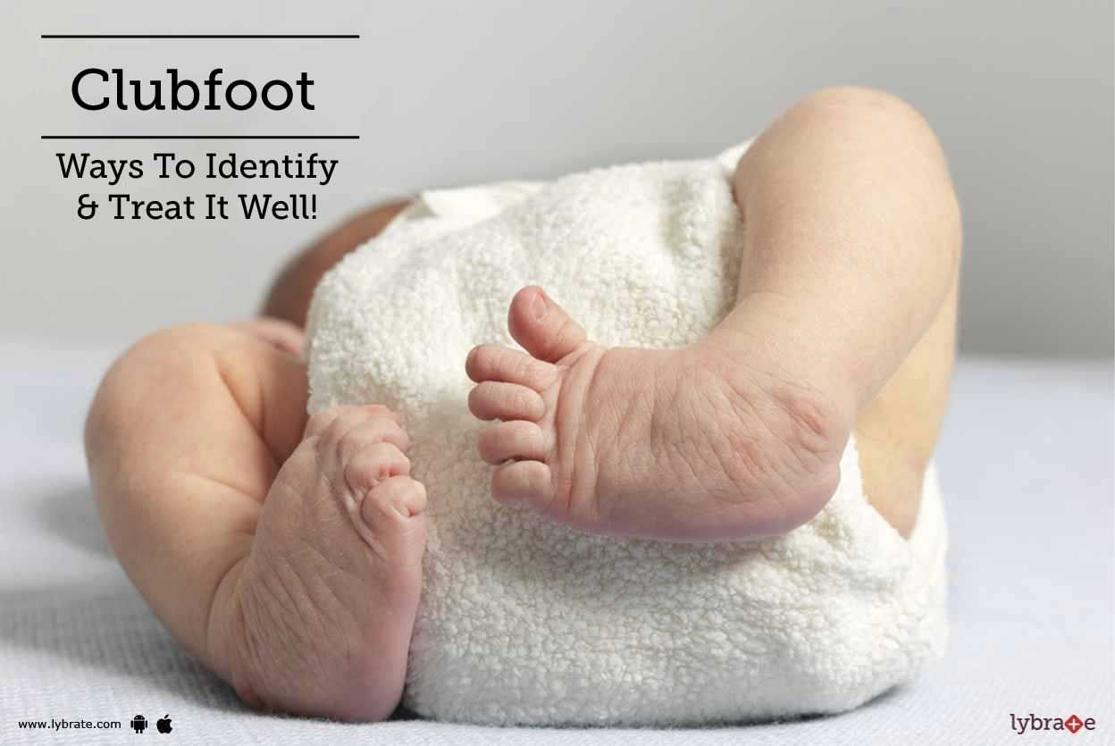 Clubfoot - Ways To Identify & Treat It Well!