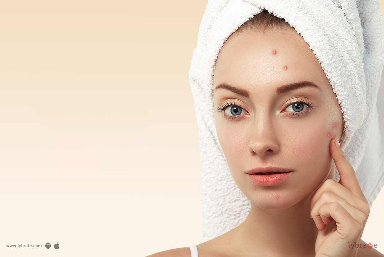 Acne - 6 Things You Can Do To Prevent It!
