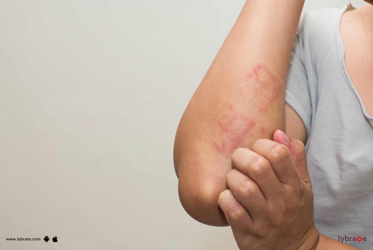 Eczema - Its Causes & Prevention!