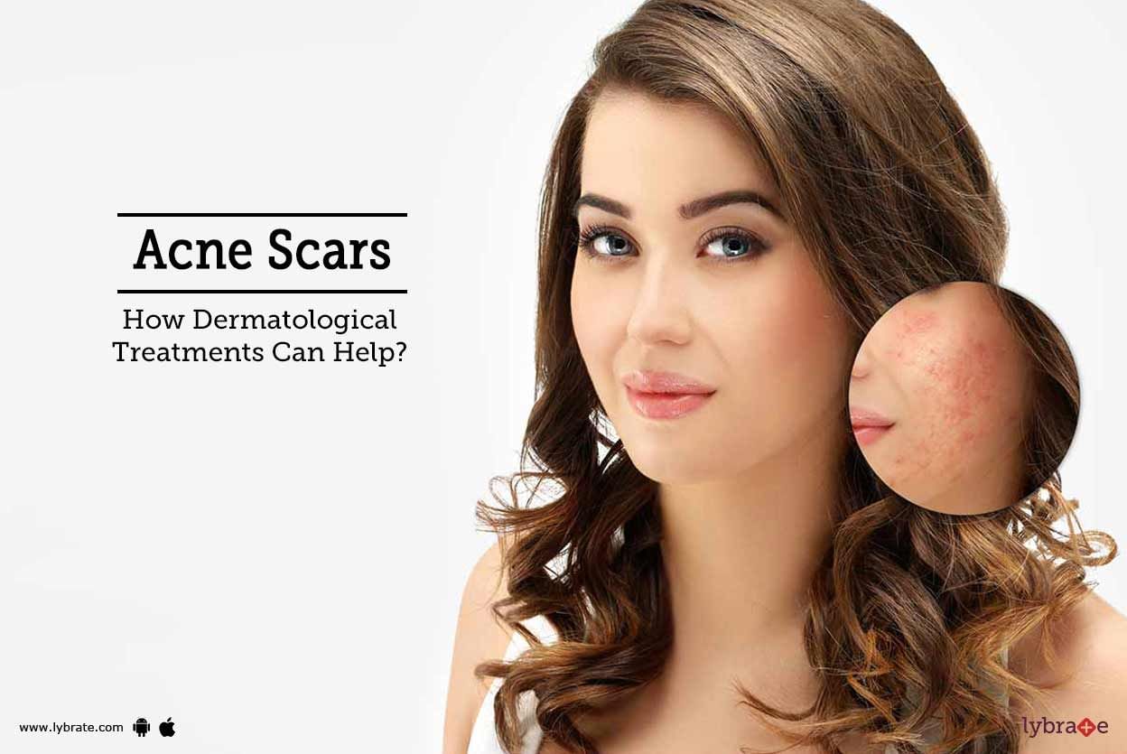 Acne Scars - How Dermatological Treatments Can Help?
