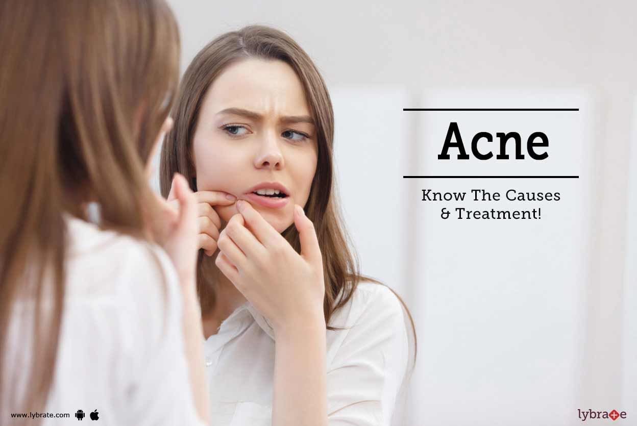 Acne: Know The Causes & Treatment!