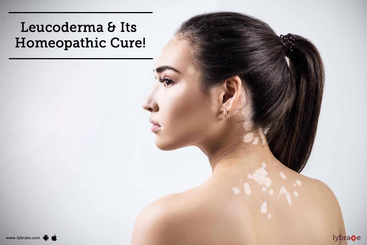 Leucoderma & Its Homeopathic Cure!
