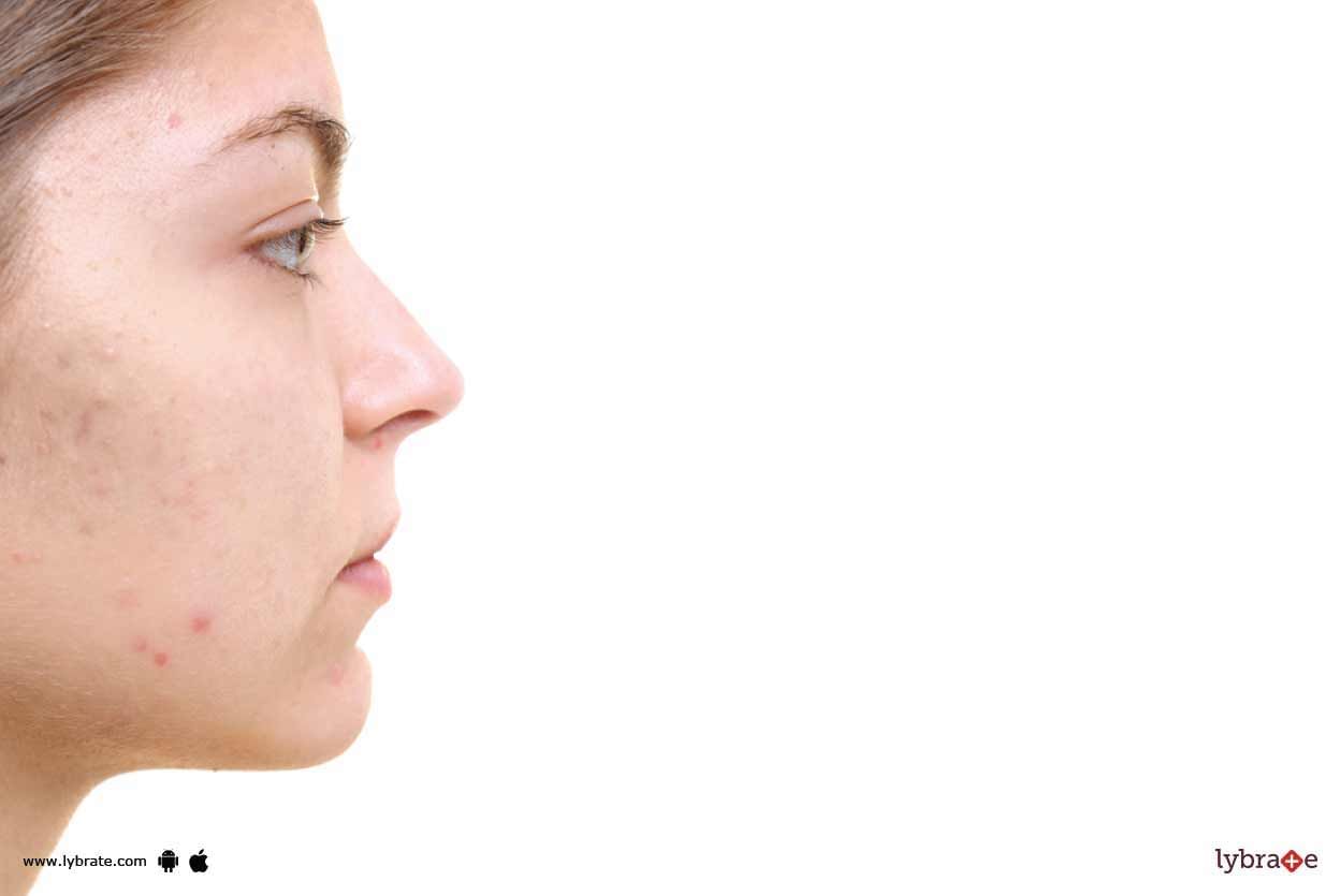 Acne Scars - Have Microneedle Radiofrequency For Them!