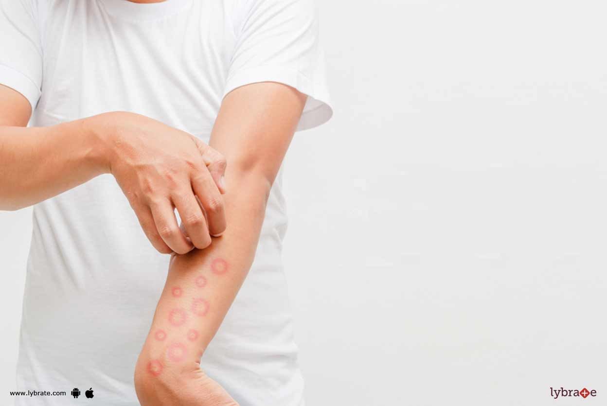Psoriasis - How Can Homeopathy Combat It?