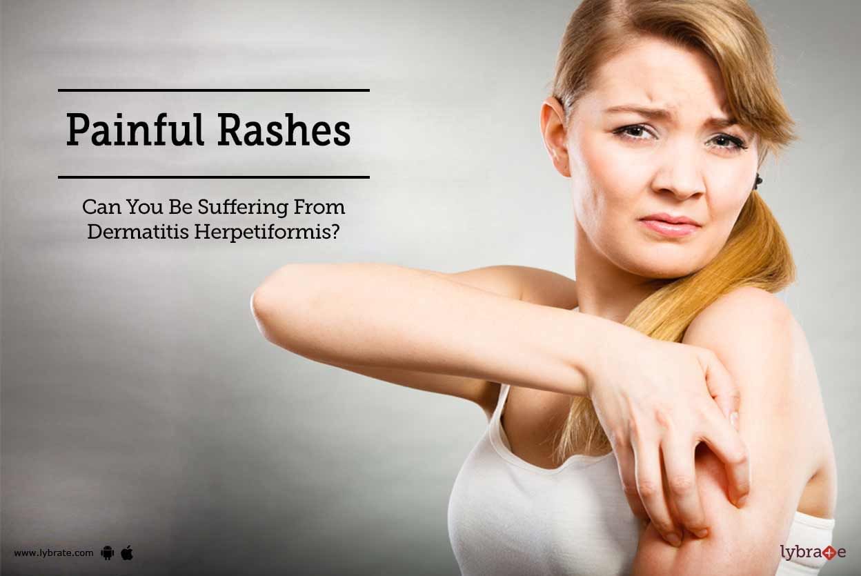 Painful Rashes - Can You Be Suffering From Dermatitis Herpetiformis?
