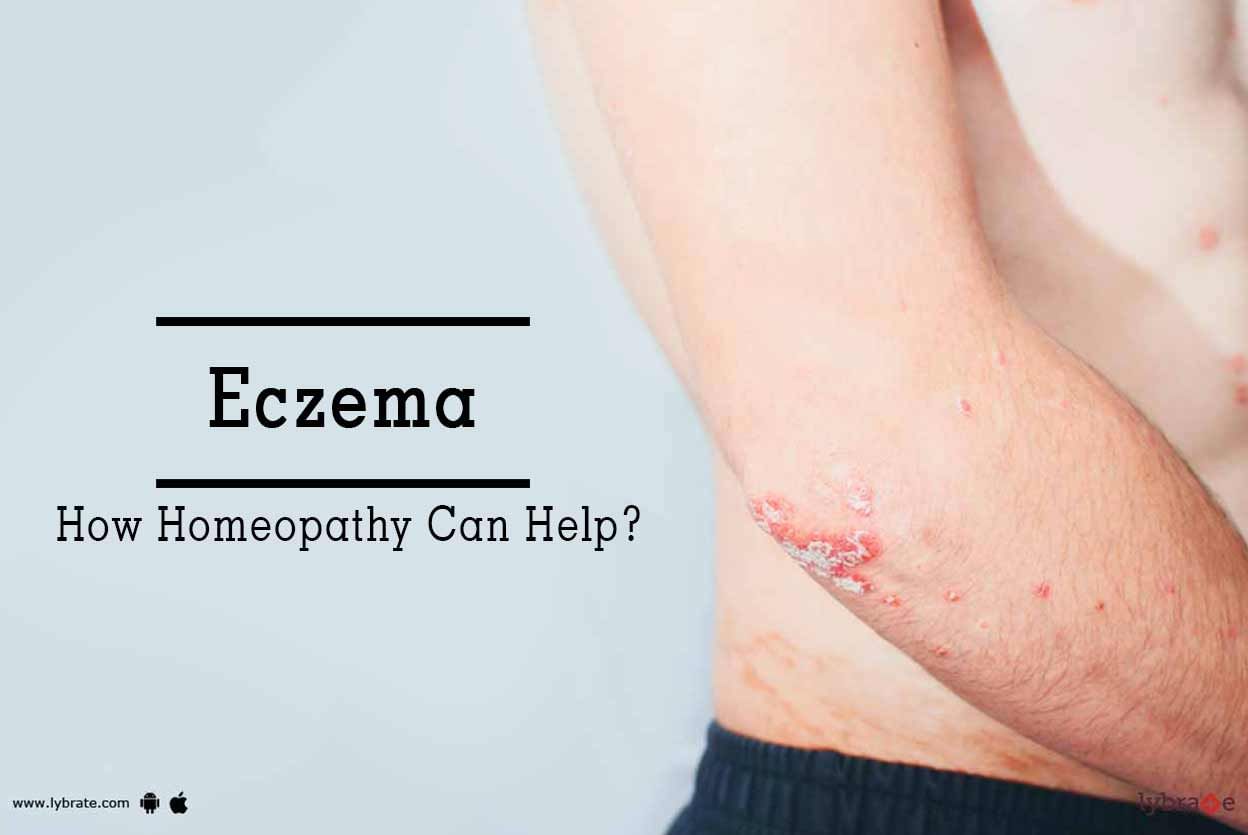 Eczema - How Homeopathy Can Help?