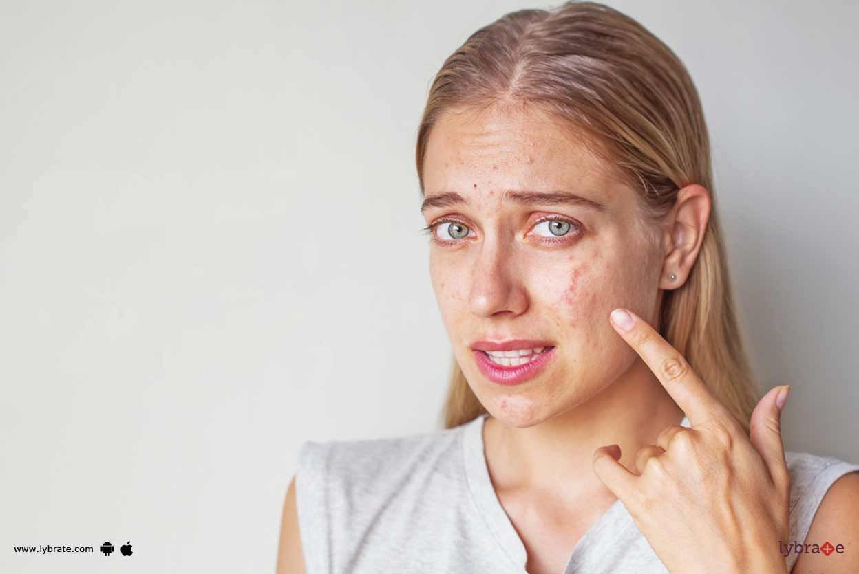 Acne & Acne Scars - Know More About Them!