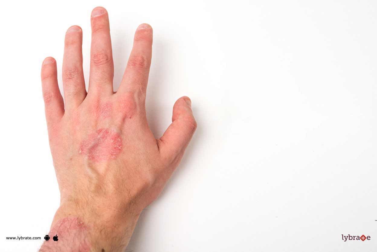 How To Treat Skin Lesions?