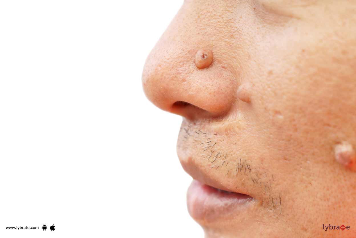 Moles & Freckles - Know Forms Of Tackling It!