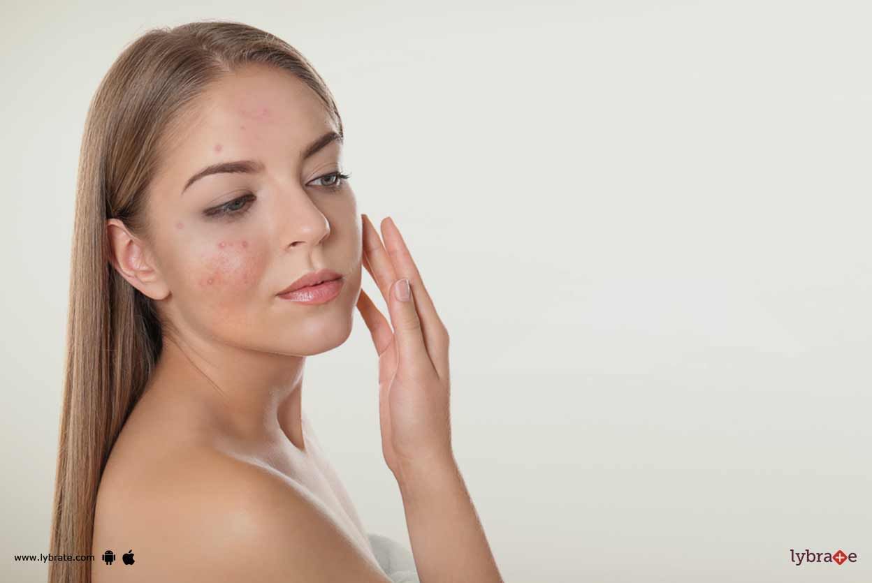 Dermatology Treatments for Acne Scarring!