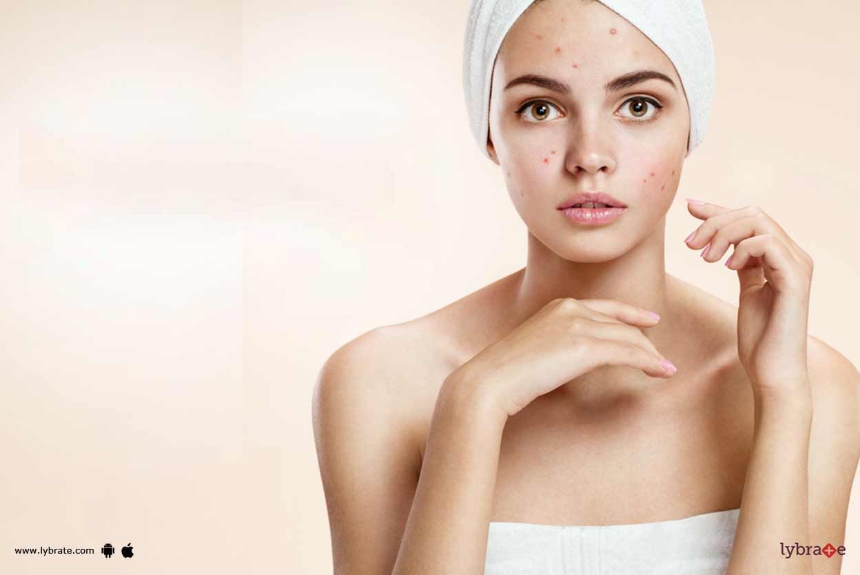 Acne Scars - Cosmetic Procedures That Can Help!