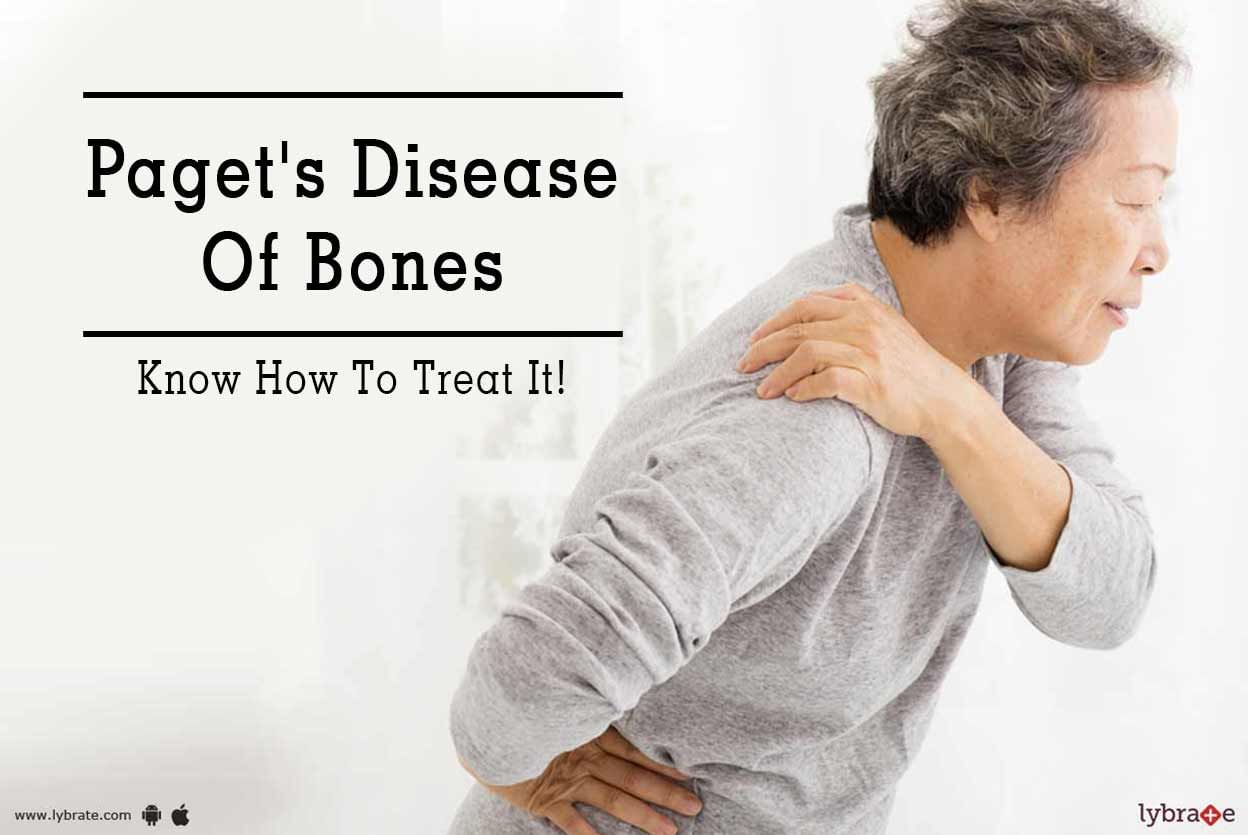 Paget's Disease Of Bones - Know How To Treat It!
