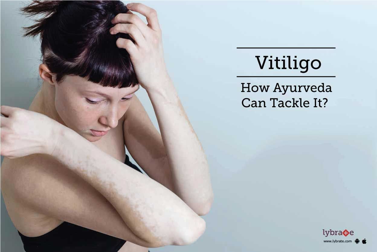 Vitiligo - How Ayurveda Can Tackle It?