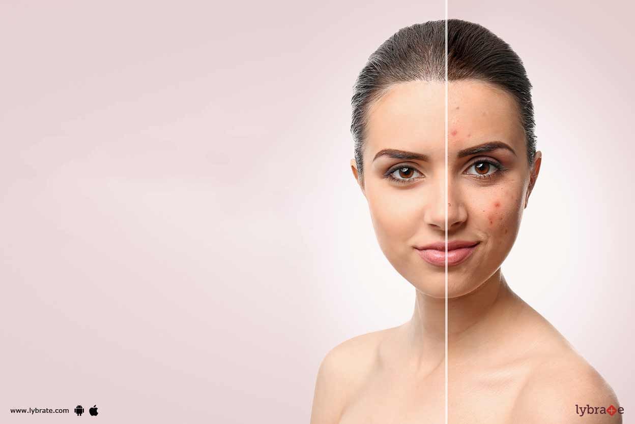 Cosmetic Procedures That Can Help With Acne Scars!