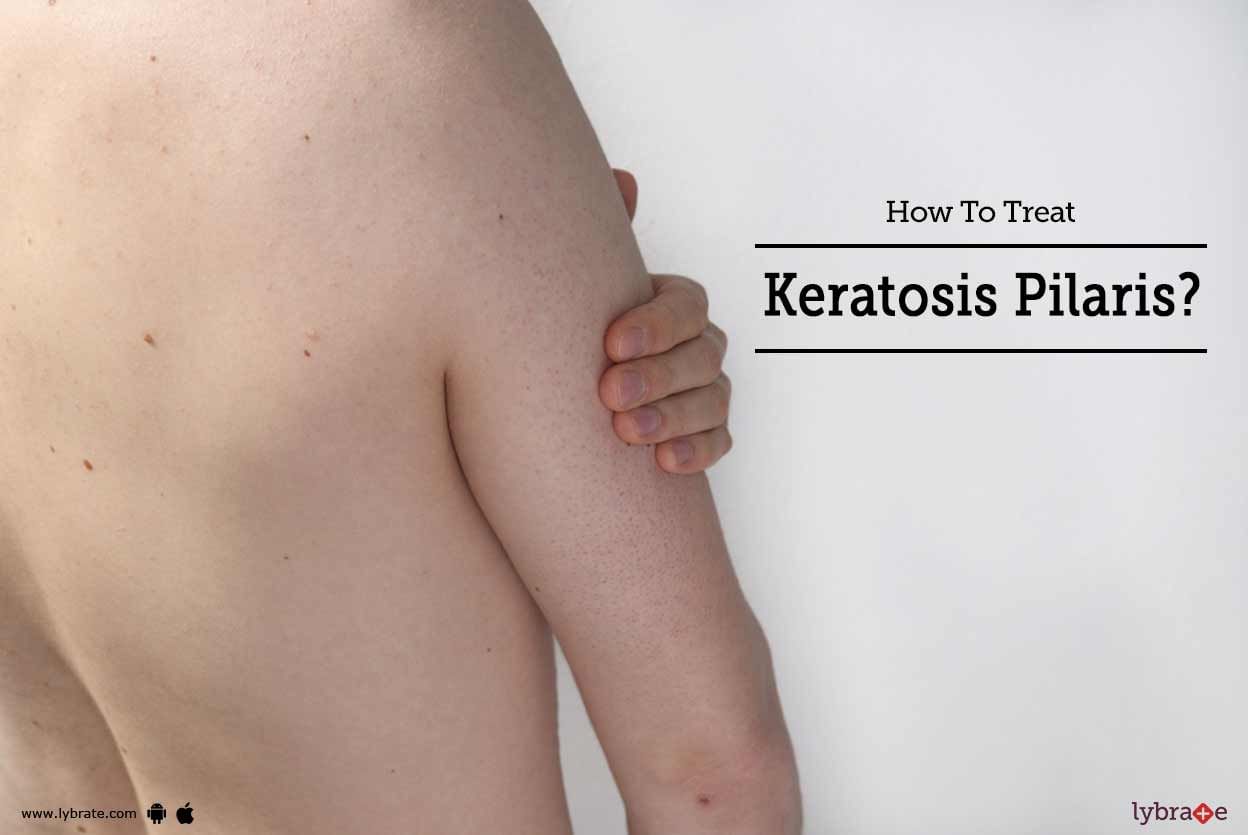 How To Treat Keratosis Pilaris?