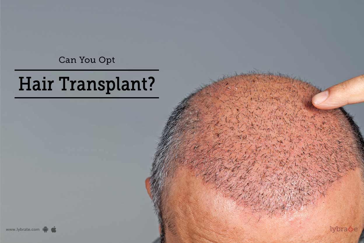 Can You Opt For Hair Transplant?