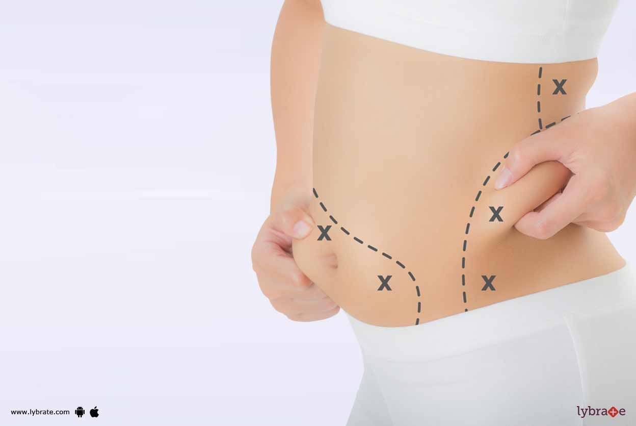 Liposuction Versus Tummy Tuck Surgery!