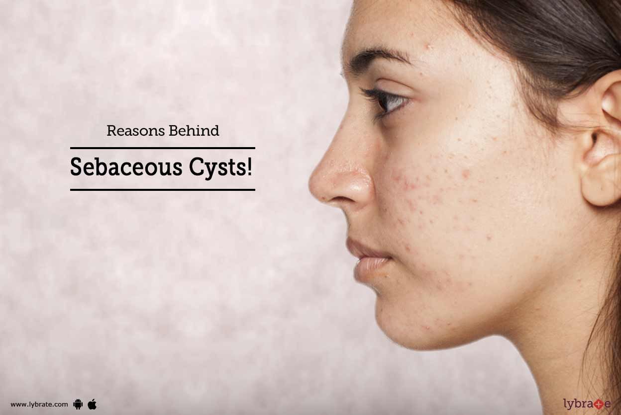 Reasons Behind Sebaceous Cysts!