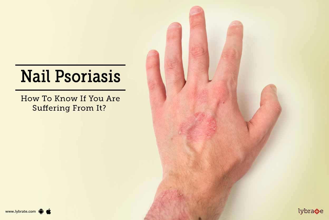 Nail Psoriasis - How To Know If You Are Suffering From It?