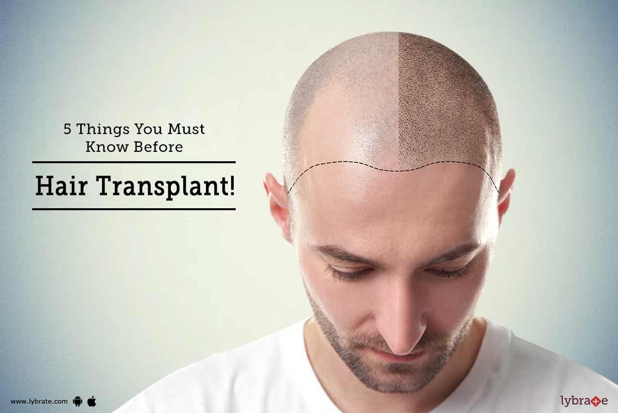 5 Things You Must Know Before Hair Transplant!