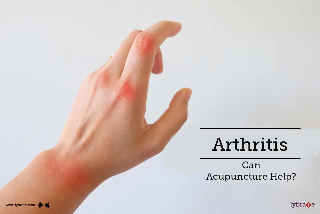 Arthritis - Can Acupuncture Help?