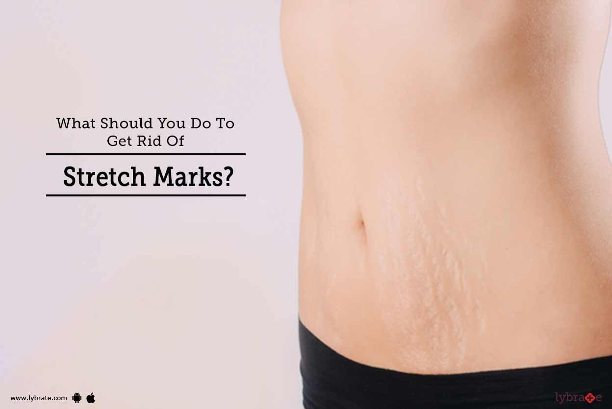 What Should You Do To Get Rid Of Stretch Marks?