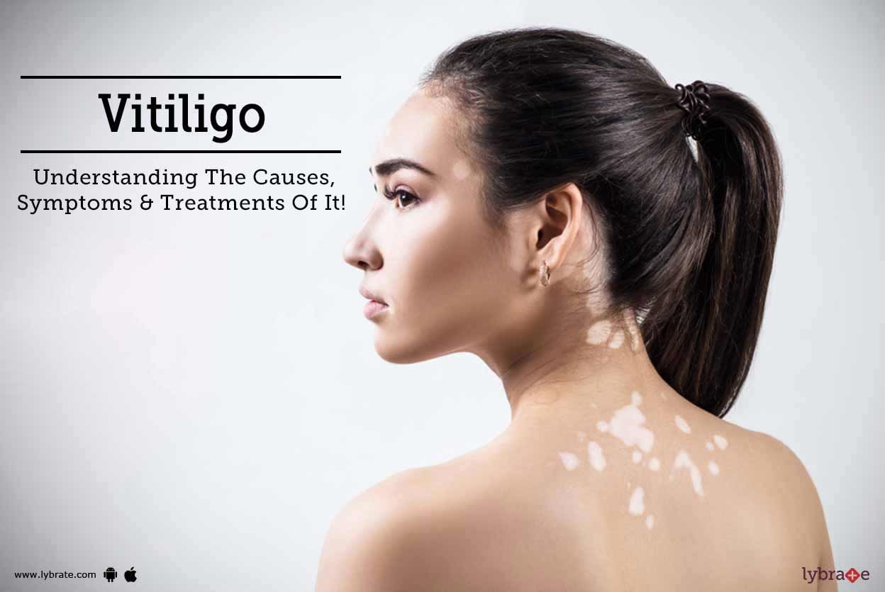 Vitiligo - Understanding The Causes, Symptoms & Treatments Of It!