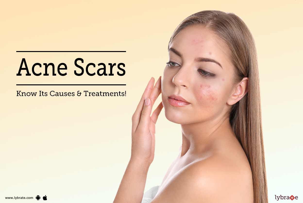 Acne Scars: Know Its Causes & Treatments!