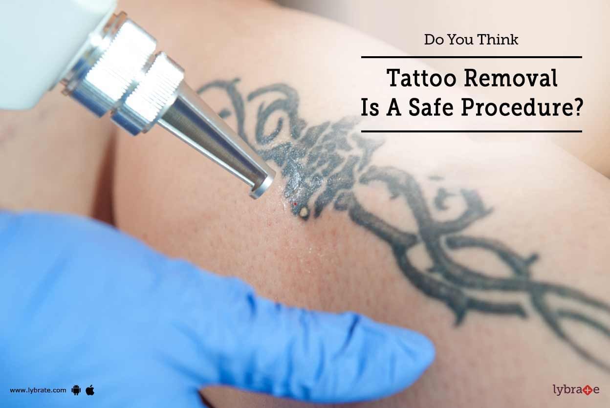 Do You Think Tattoo Removal Is A Safe Procedure?
