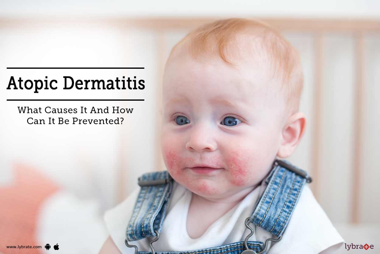 Atopic Dermatitis - What Causes It And How Can It Be Prevented?