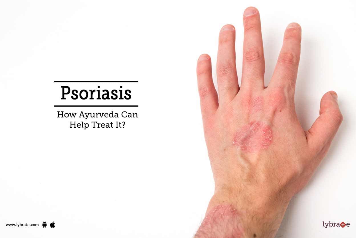 Psoriasis - How Ayurveda Can Help Treat It?
