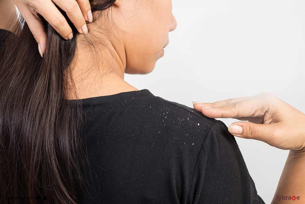 Dandruff - How Can It Impact Your Skin?