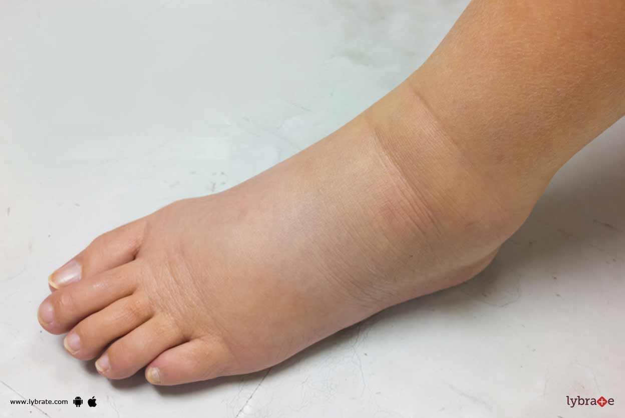 Swollen Feet, Ankles, and Hands - How To Handle It  While You Are Pregnant?