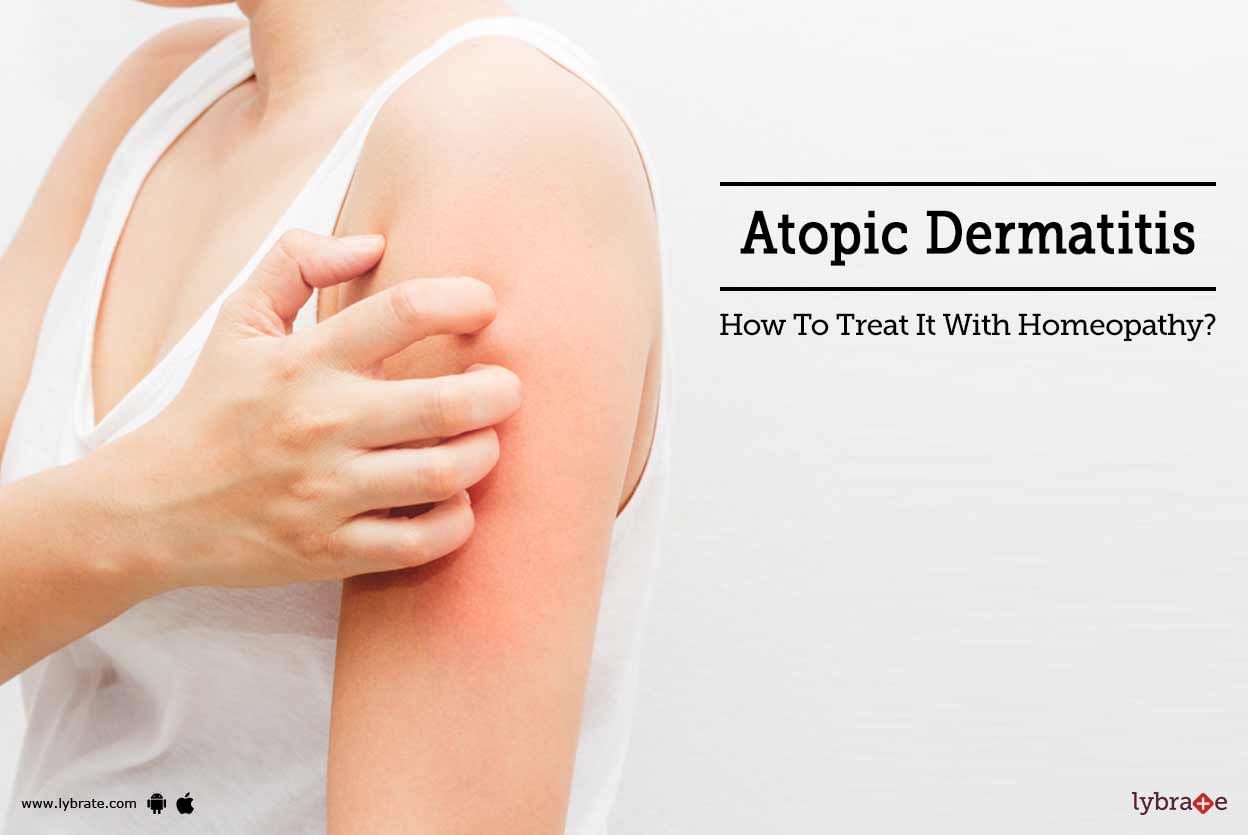 Atopic Dermatitis - How To Treat It With Homeopathy?