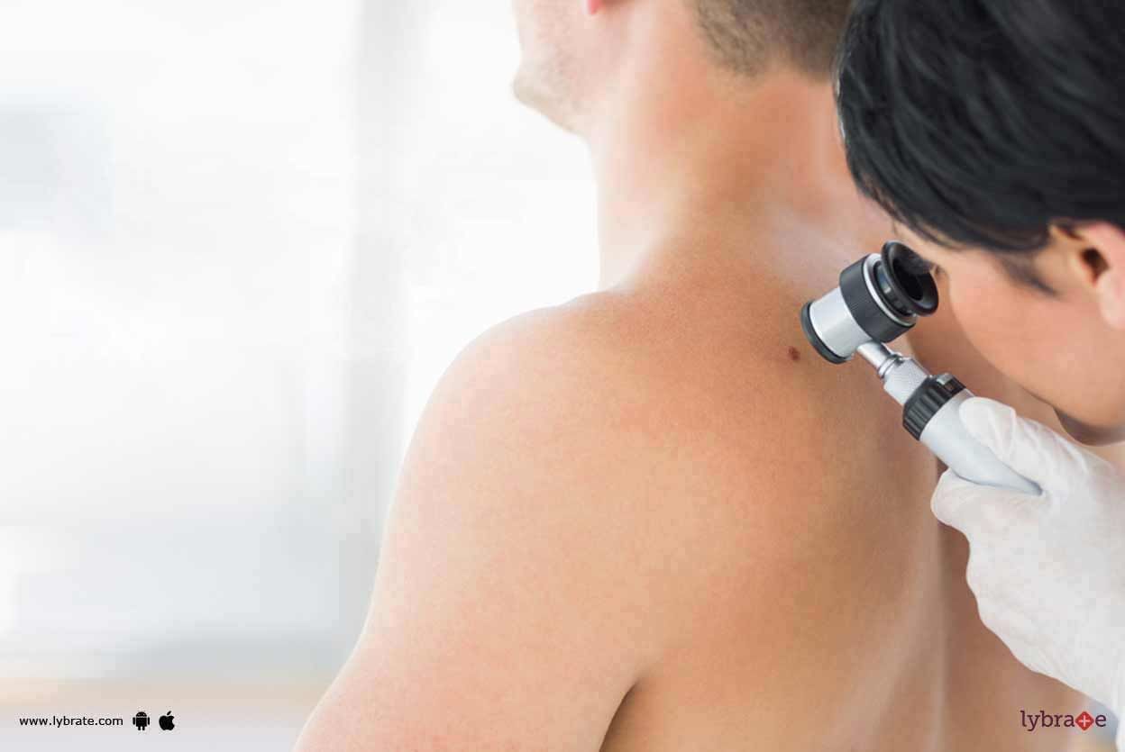 Skin Cancer - Are You At Risk?