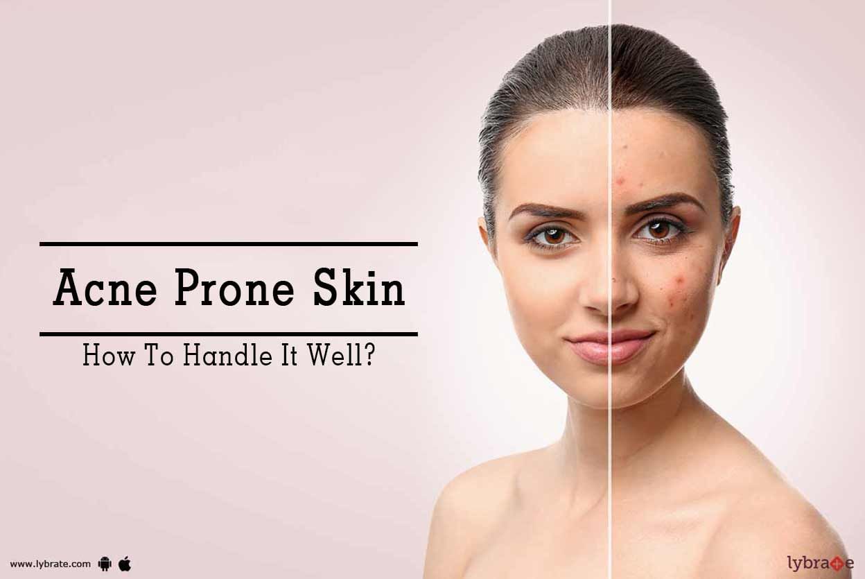 Acne Prone Skin - How To Handle It Well?