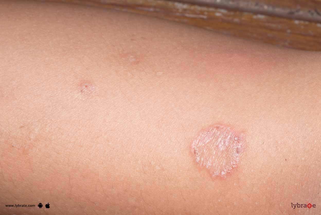 Lichen Planus - How Can Homeopathy Tackle It?