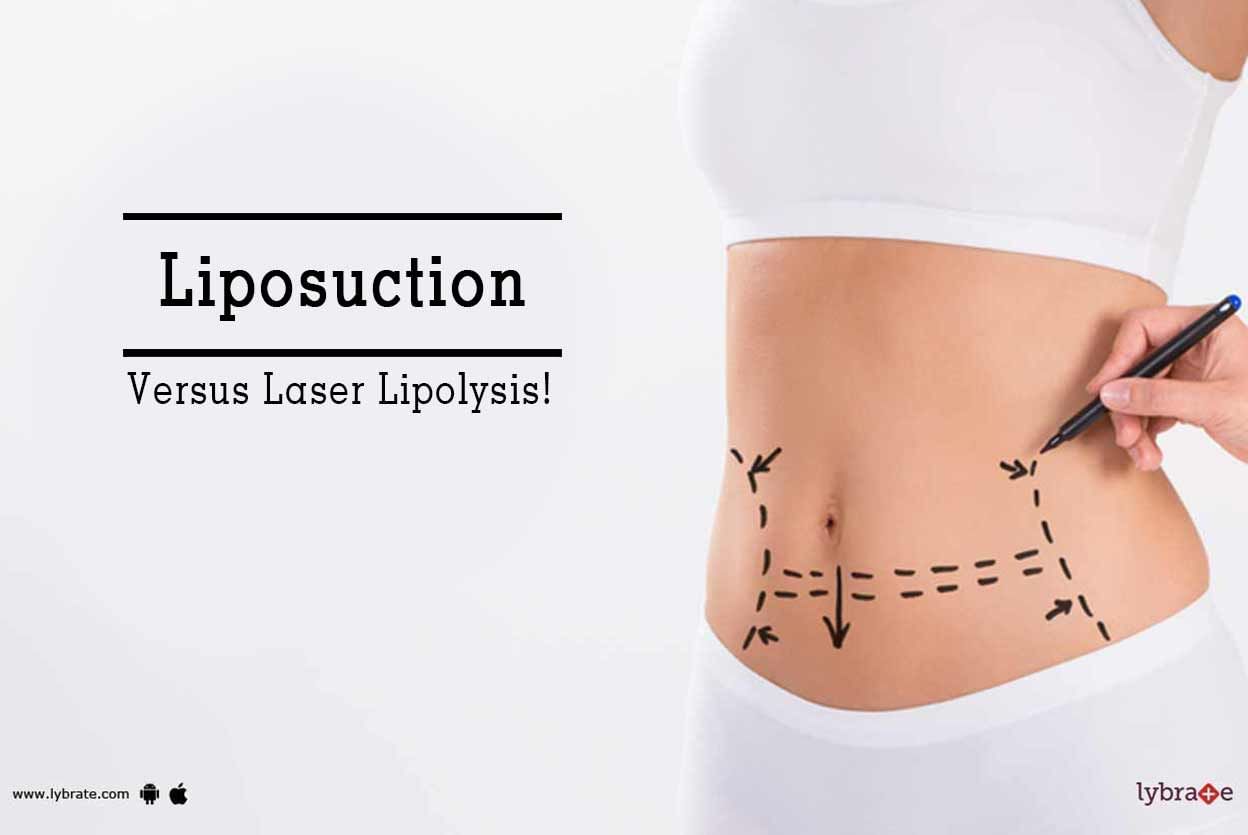 Liposuction Versus Laser Lipolysis - Which One Is Better?