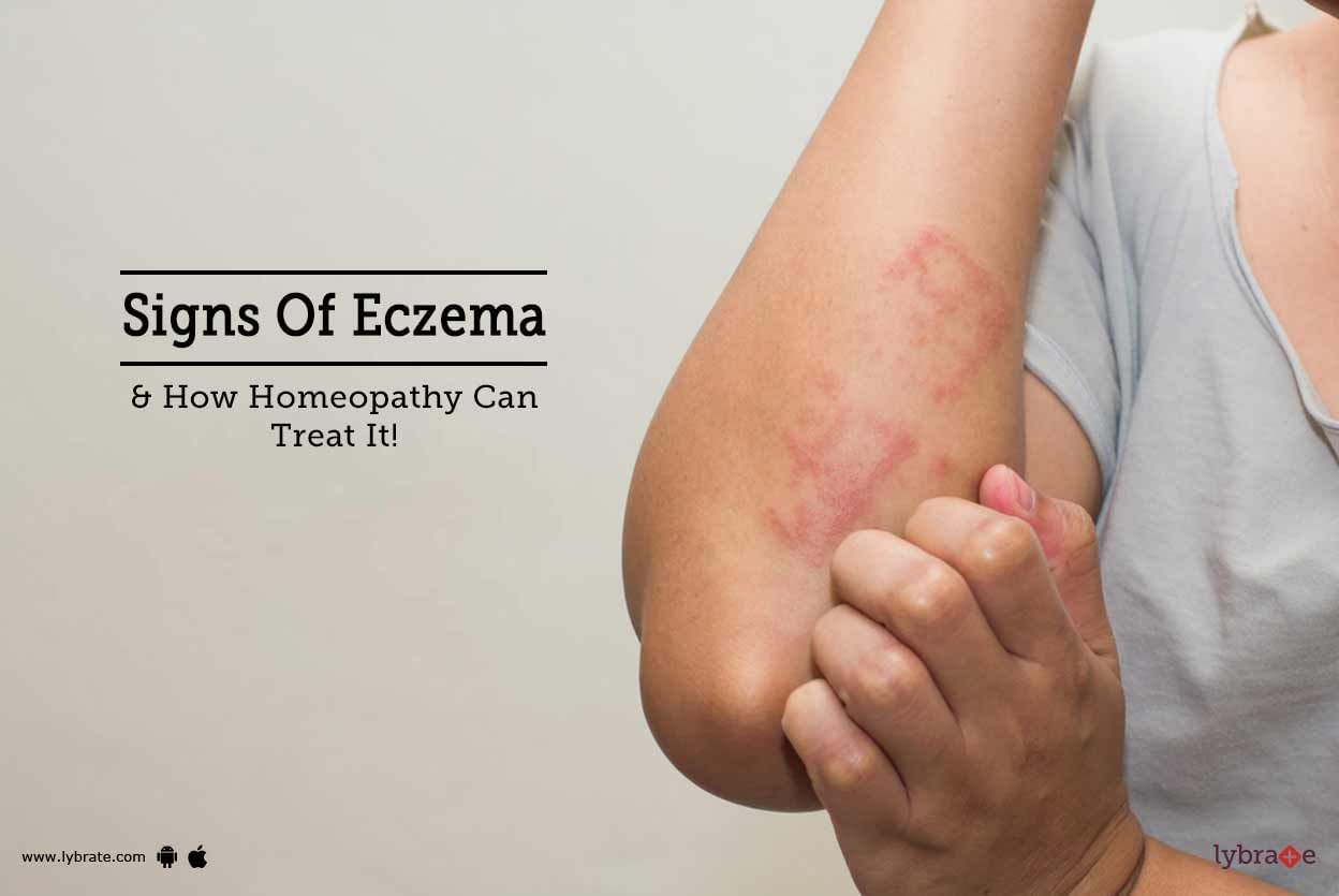 Signs Of Eczema & How Homeopathy Can Treat It!