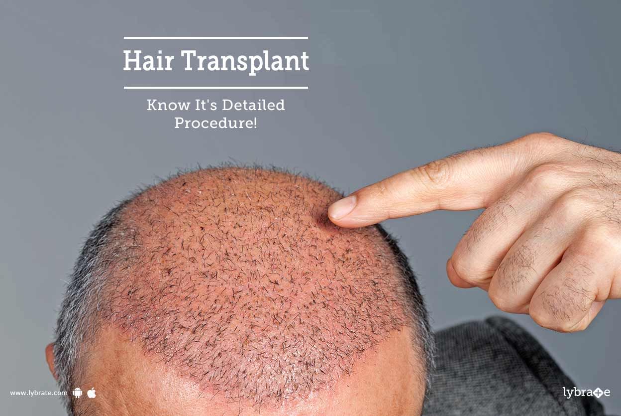 Hair Transplant - Know It's Detailed Procedure!