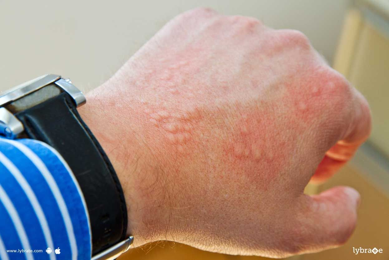 Contact Dermatitis - Know Signs Of It!
