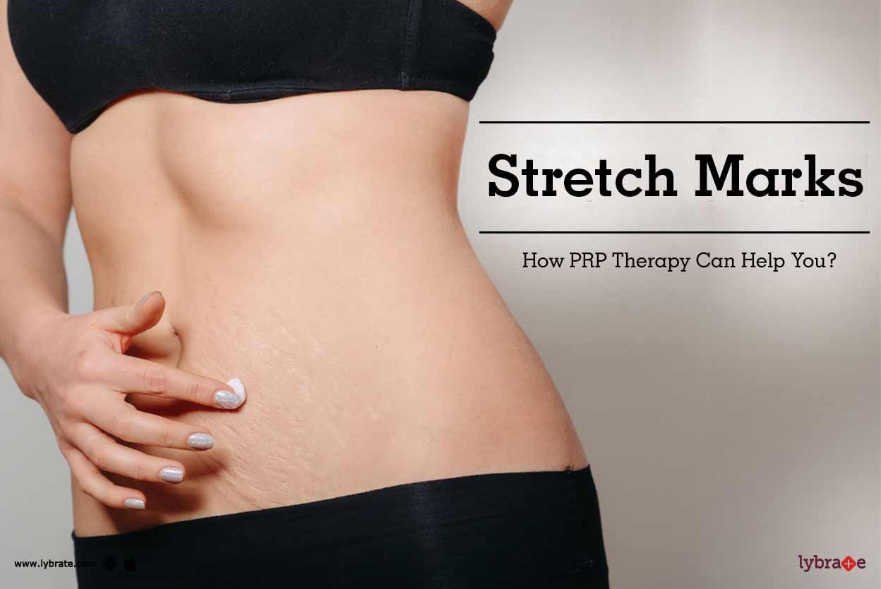 Stretch Marks - How PRP Therapy Can Help You?