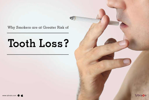 Why Smokers are at Greater Risk of Tooth Loss?