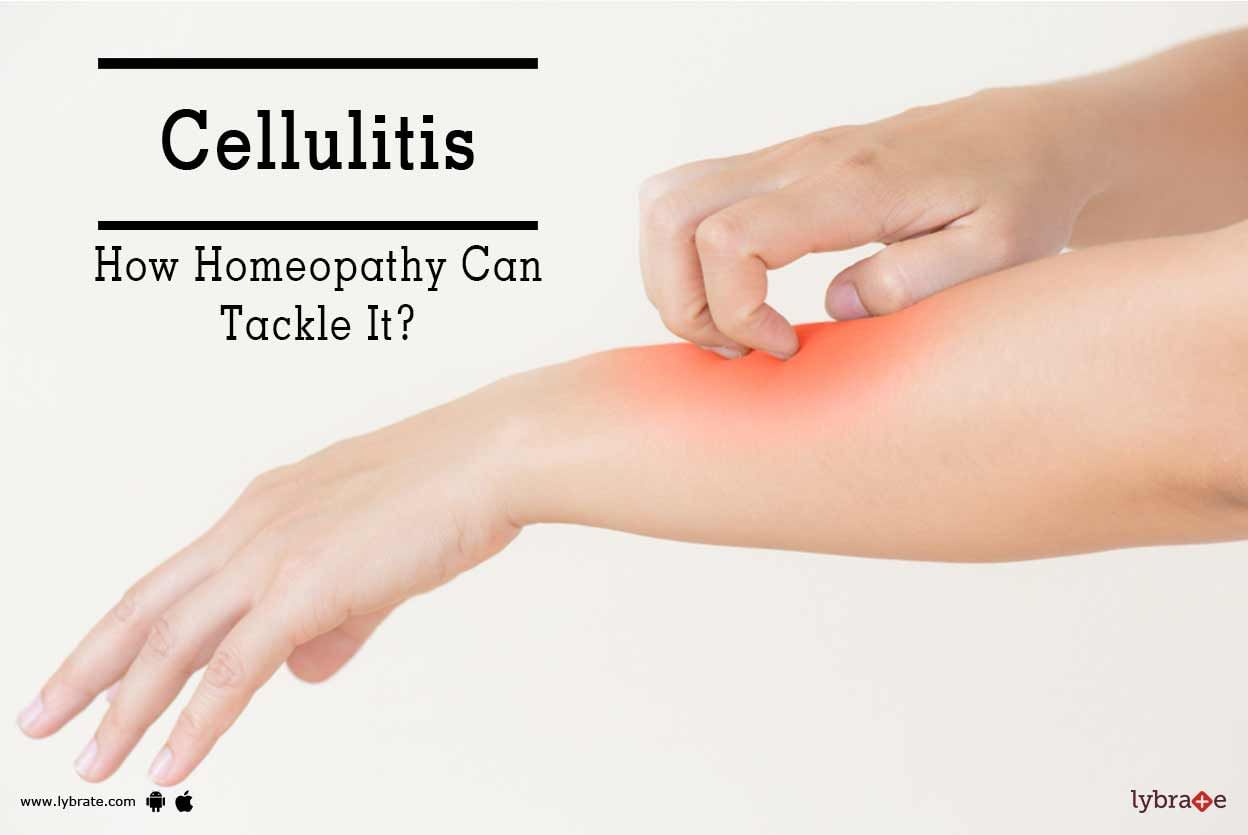 Cellulitis - How Homeopathy Can Tackle It?
