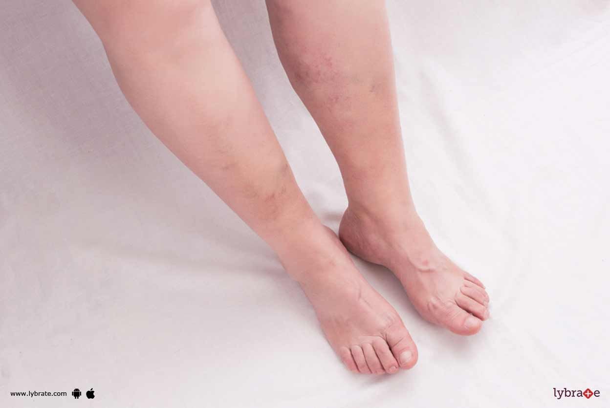 Blood Clots In Legs - Are They Preventable?