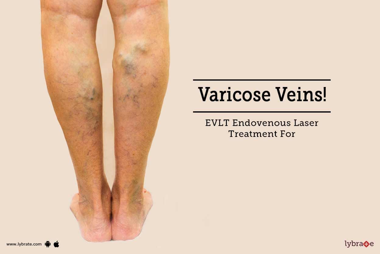 EVLT Endovenous Laser Treatment For Varicose Veins!