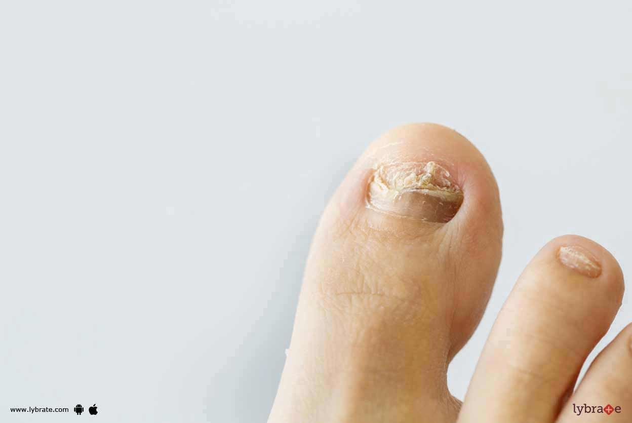 Fungal Infection In Nails - How To Administer It?