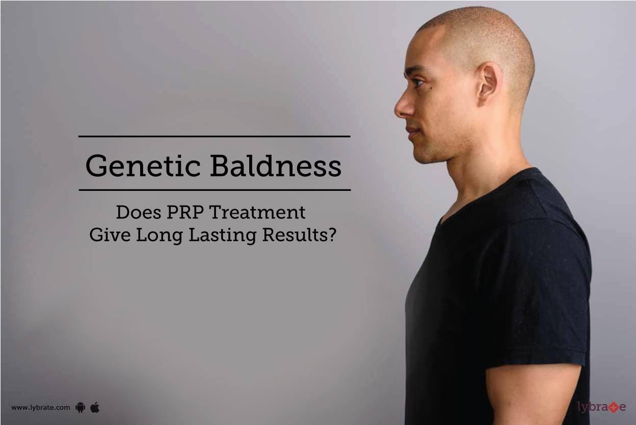 Genetic Baldness - Does PRP Treatment Give Long Lasting Results?